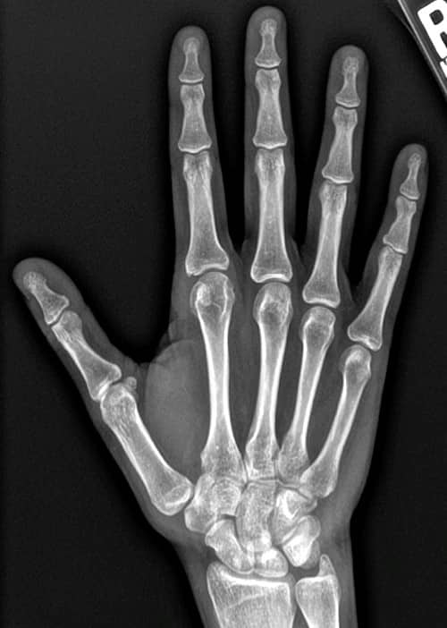 X Ray scan of Dillion's Hand