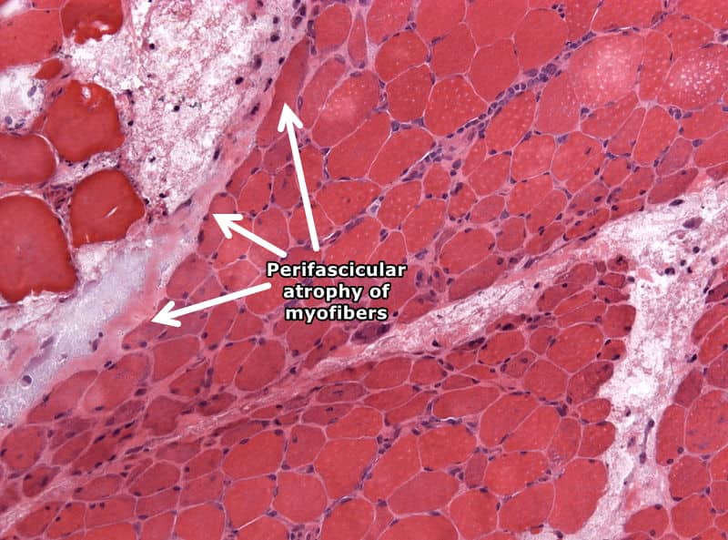 Perifascicular atrophy of myofibers, white arrows pointing at light pink marble muscle fibers surrounded by a darker pink muscle fibers.