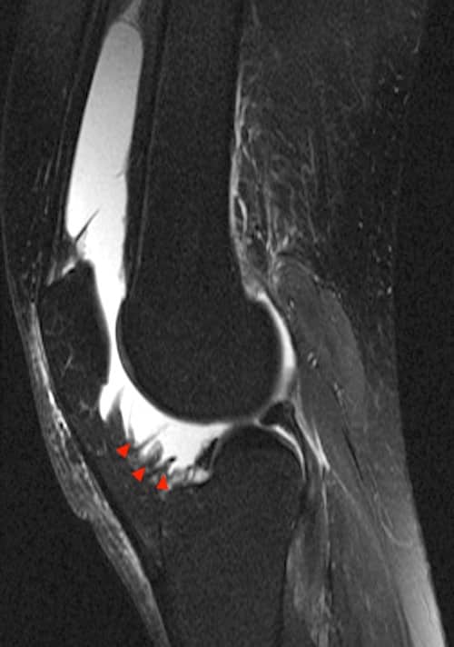 MRI scan of Dillion's Knee