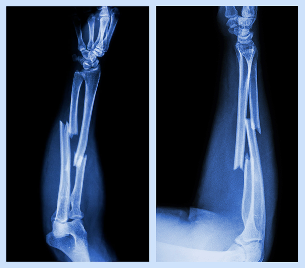 Ulnar and Radial Fracture image