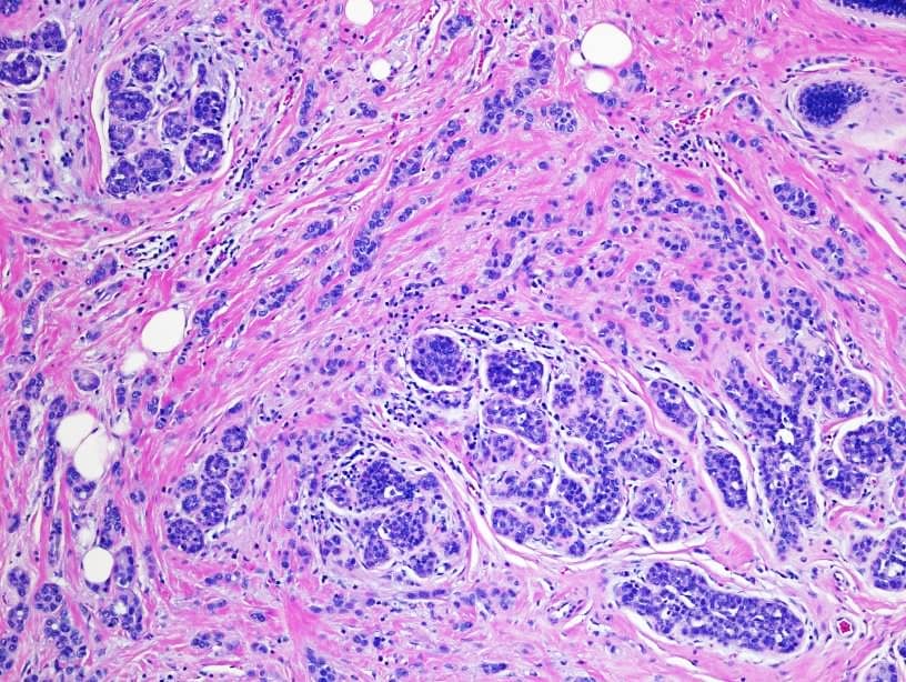 Prue Histopathology of invasive lobular carcinoma, next to lobular carcinoma in situ