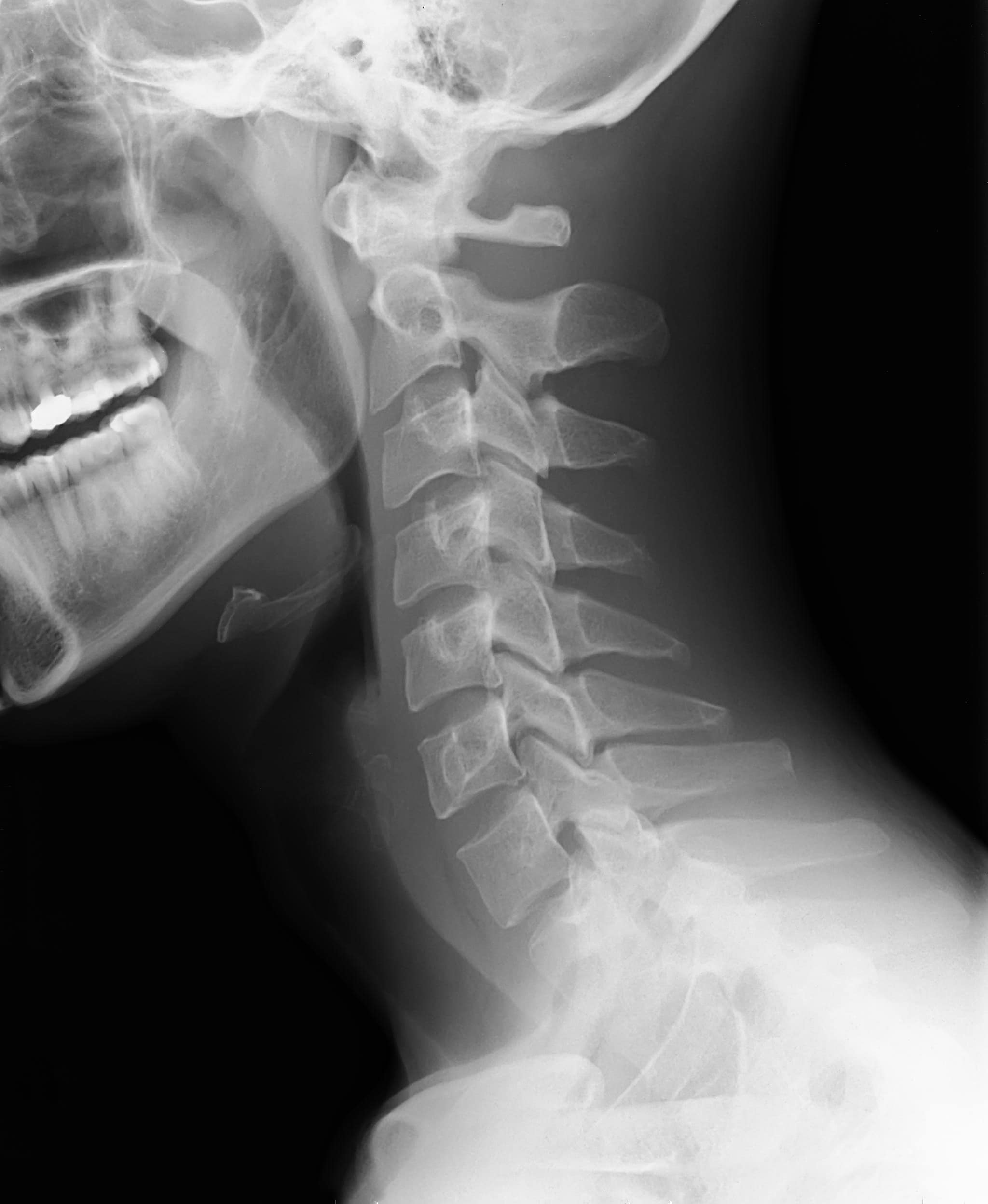 Normal X-ray
